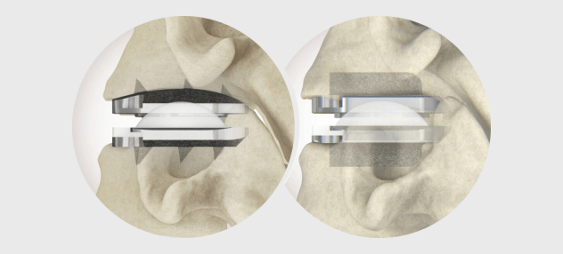 Centinel Spine® Receives MDR Certification for prodisc® C Vivo and prodisc® C Nova Cervical Total Disc Replacement Systems