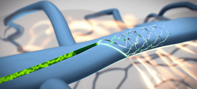ALS patient is 1st to control iPad by thought with implantable brain sensor
